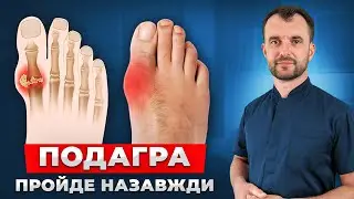 Подагра: лікування вдома БЕЗ ОПЕРАЦІЙ. Як просто вивести сечову кислоту