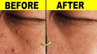 9 Effective Ways To Remove Skin Tags At Home