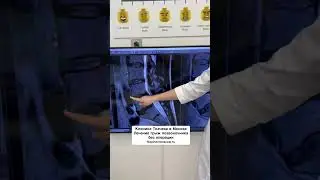 Грыжа диска L4-L5. Лечение по методу резорбции в Клинике Ткачева в Москве.