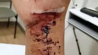 Fractured Wrist Surgery Recovery - Splint removal after Wrist Surgery