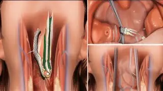 ASMR clean up the girl's mouth and treatment fish bones from her oral cavity | deep cleaning asmr