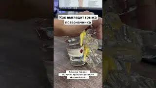 Как выглядит грыжа позвоночника. #новости #здоровье
