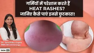 Heat Rashes (घमोरियां) से कैसे बचे? | Prickly Heat in Babies | Tata 1MG