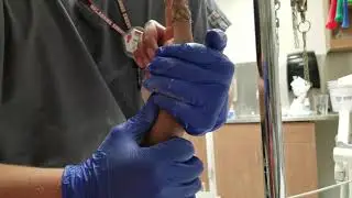 Fractured Wrist Recovery: 1 Resetting The Wrist