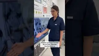 Грыжа диска появилась из-за кастрюли. Можно ли избавиться от нее без операции? #грыжапозвоночника