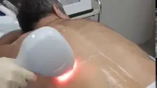 Лазерная эпиляция спины диодным лазером