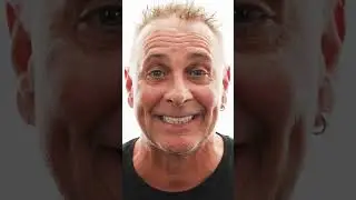 Justin’s Before and After Amazing Smile Transformation