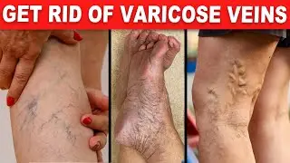 9 Natural Ways to Get Rid of Varicose Veins and Increase Blood Flow