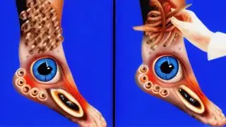 ASMR Removal Dog Ticks & Maggot Infected Armpit | Severely Injured Animation