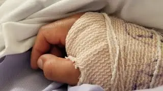 Fractured Wrist Surgery, Fractured Distal Radius