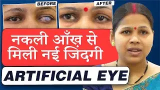 Artificial Eye | Prosthetic Eye | Artificial Scleral Eye Shell - Evisceration with Implant surgery