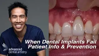Dental Implant Failures - Patient Information and Prevention