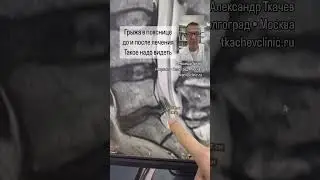 Грыжа в пояснице L5 S1 до и после лечения. #резорбциягрыжи