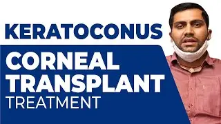 Treatment of Acute Corneal Hydrops in Keratoconus by Full-Thickness Corneal Transplant (PK)