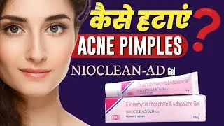 Acne Aur Pimple Kaise Hataye | Clindamycin And Adapalene Gel | Nioclean AD Gel For Pimples